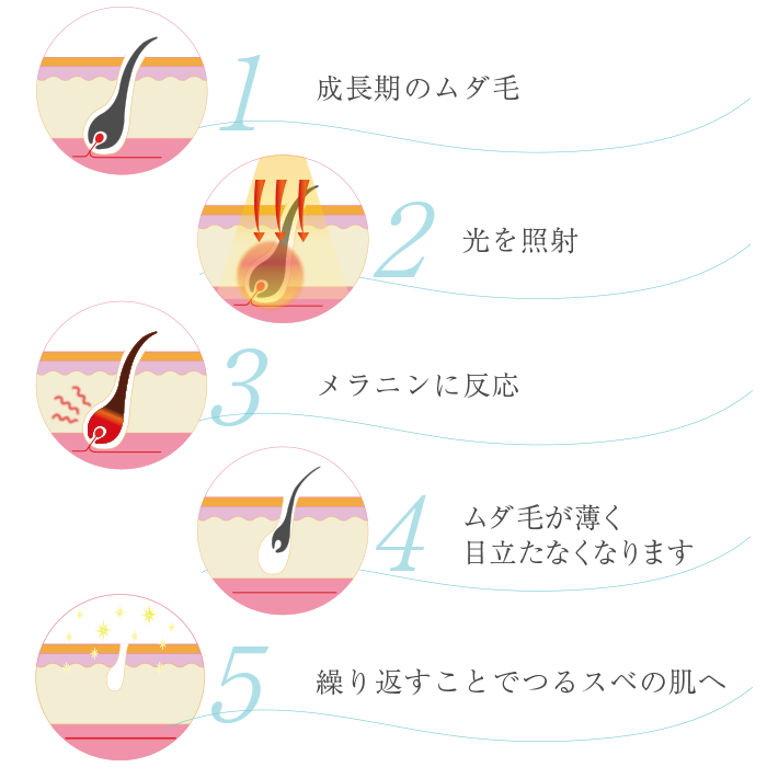 光脱毛のしくみ